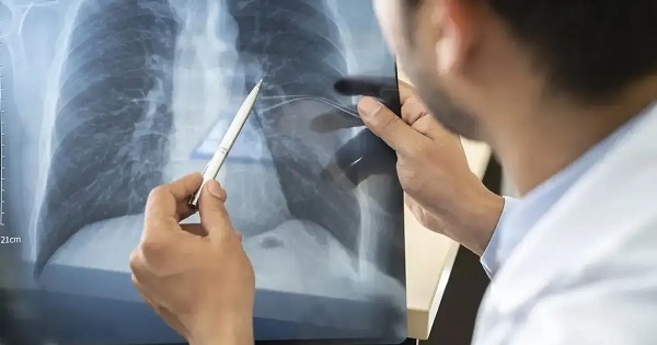 Anvisa aprova novo medicamento para câncer de pulmão avançado