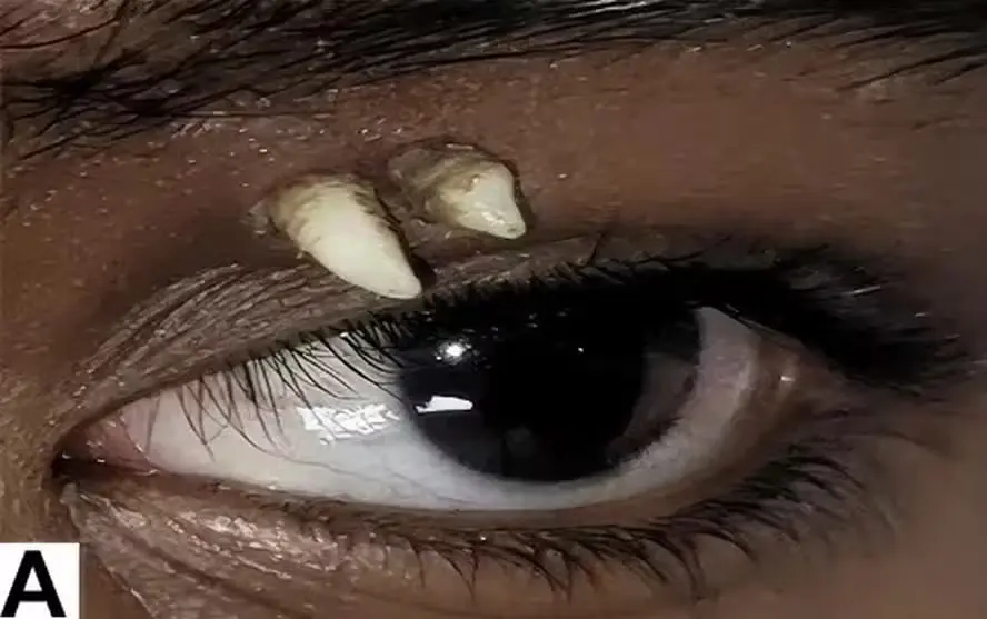 Adolescente tem dente retirado de região próxima ao olho; médica explica anomalia